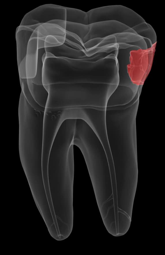 Caries