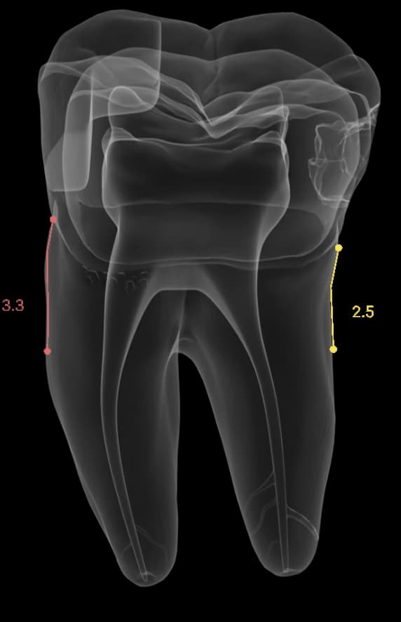 Bone Levels