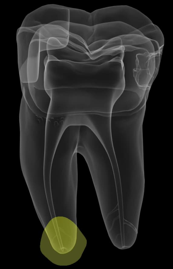 Periapical Radiolucency (PARL)